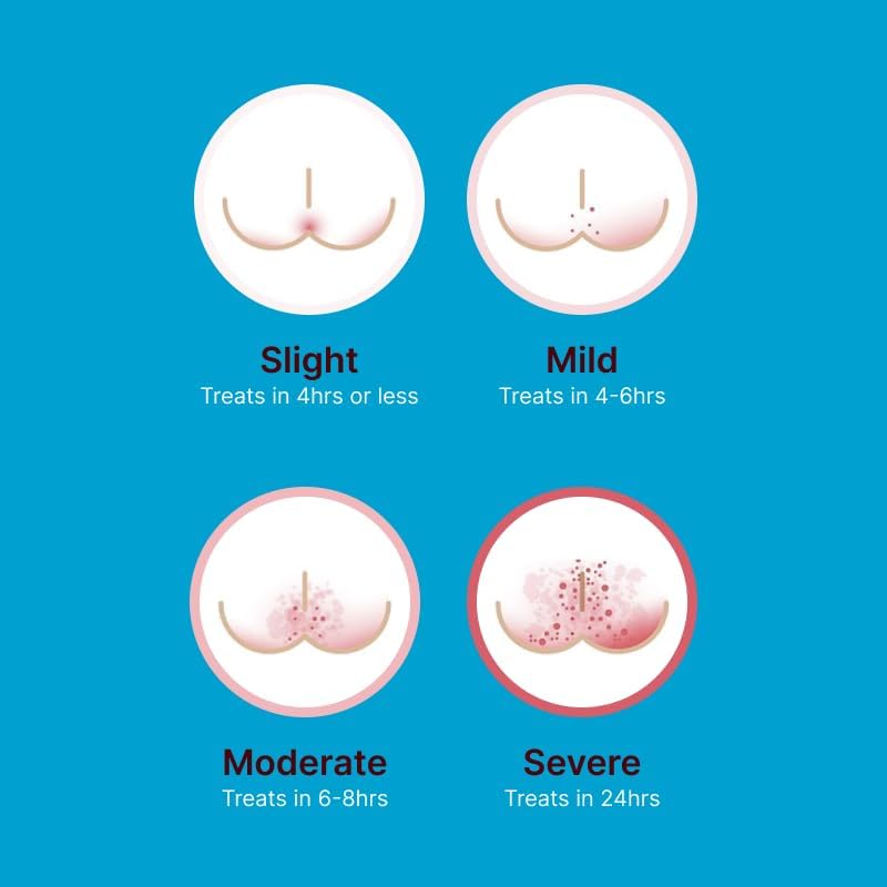 Baby Butz Diaper Rash Cream, 100% Natural, Zinc Oxide Paste for Prevention, Treatment & Relief, Fragrance Free, 113g - LittleTreasures